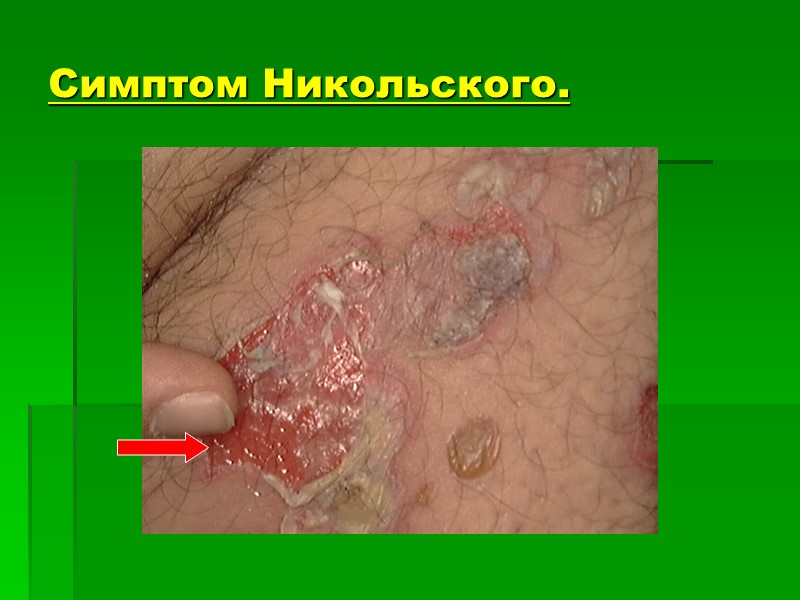 Симптом Никольского.